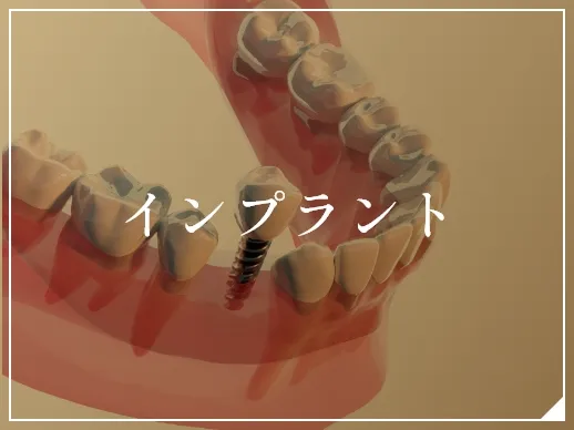 インプラント
