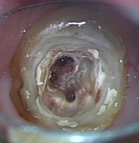 ［使用例①］歯根の治療